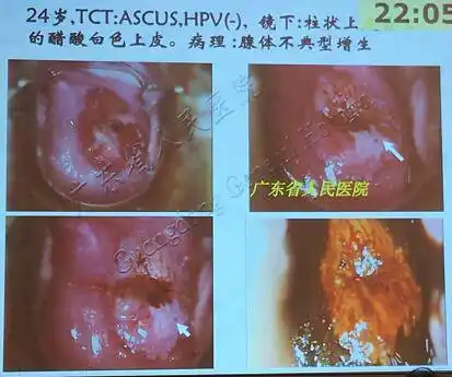 宫颈腺癌,早期诊断不容忽视!
