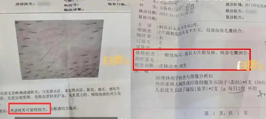 新闻中显示的皮肤镜报告符合休止期脱发的特征,检查意见也提示"枕秃