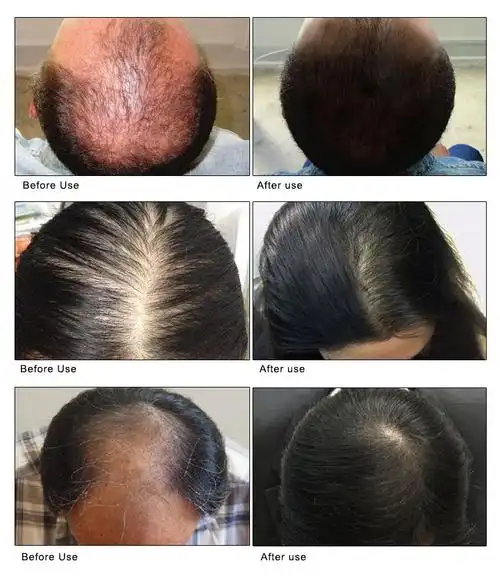 artiscare 头发喷雾 精华 精油 柔顺营养强韧头皮发根精华液 跨境