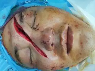 朋友面部被砍伤11.5cm被鉴定为轻伤 求问这个鉴定是否对