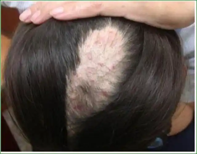 女生的头癣初期图片_有来医生