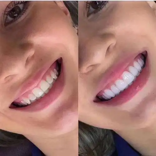 只认何穗的露齿笑最美,她的美牙却成为了追捧的对象.