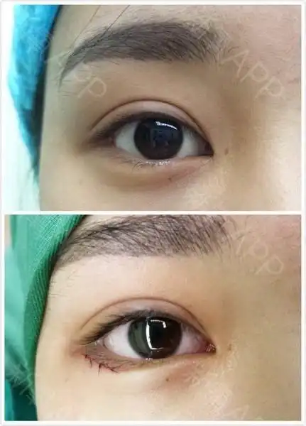 术后三天刚想起来写日记.送大家一个反馈图