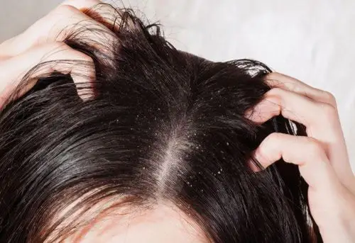 头油头痒反复发作?教你2种方法加2种植物,恢复头皮舒适干爽