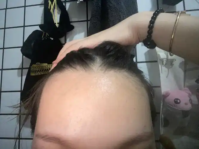 女生发际线方怎么办