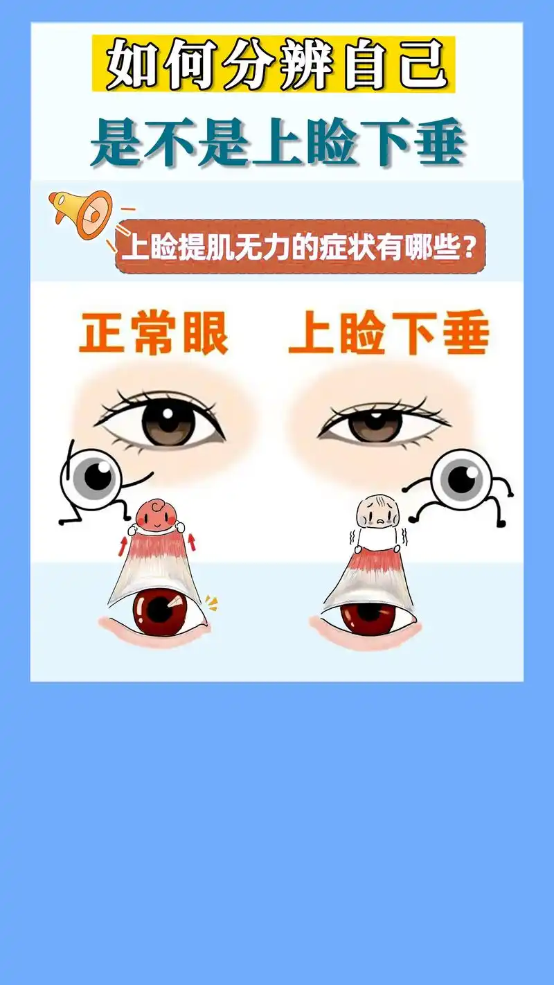 教你如何分辨自己是不是上睑下垂#双眼皮 #变美 #医学科普  - 抖音