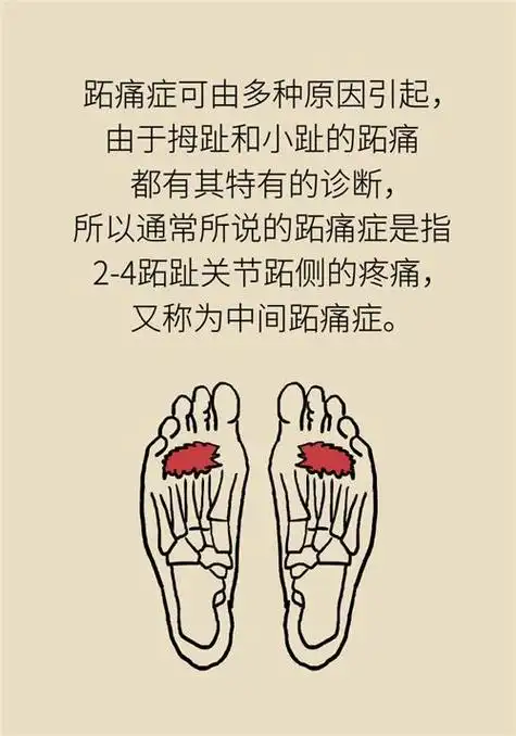 前脚掌起老茧一踩地就疼痛?当心这可能是跖痛症