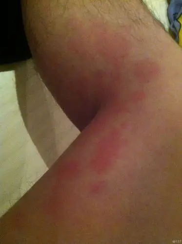 双下肢膝盖内侧有皮疹不痒不痛症状加重