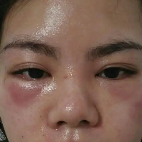 用绿肌本脸过敏成这鬼样.