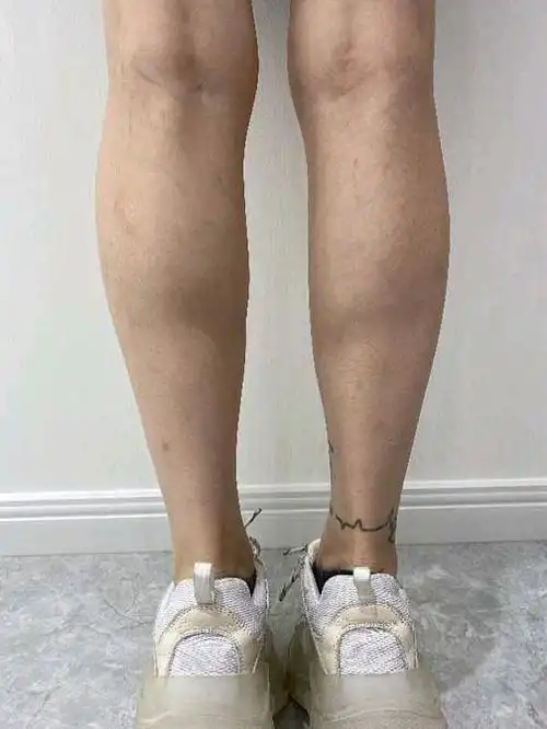 我就是因为经常跑步导致的小腿肌肉比较发达,一大块肌_圈子-新氧美容