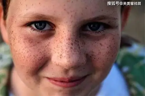 脸上长雀斑该怎么办?