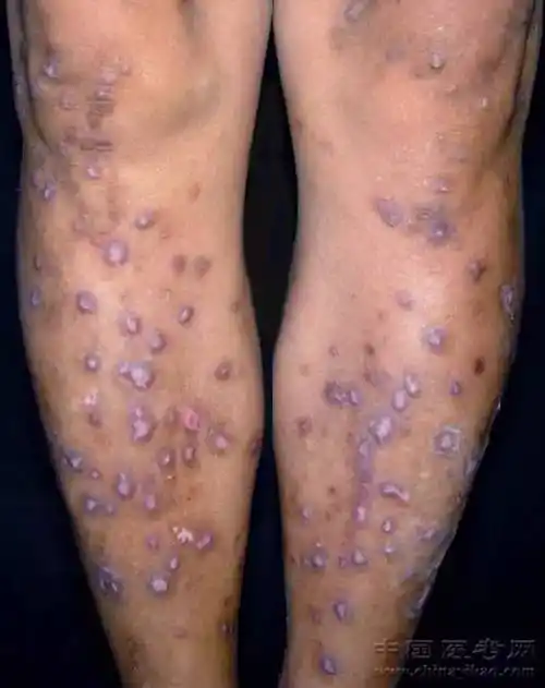 超珍贵皮肤病图谱!还剩99张,都给你了