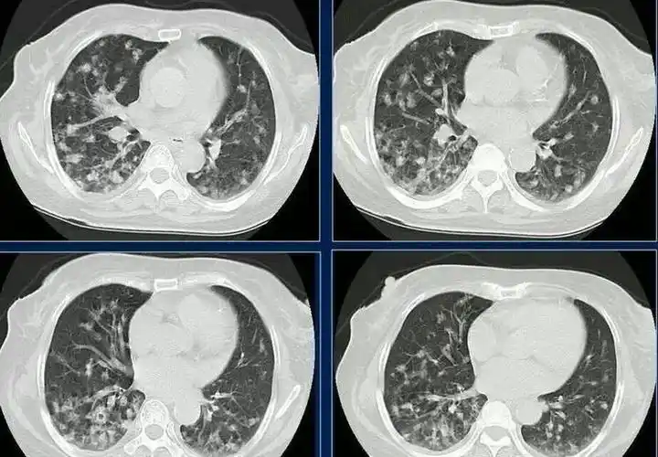 终生难忘的1例肺结核