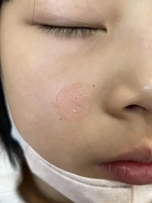 体癣_体癣症状表现 - 好大夫在线