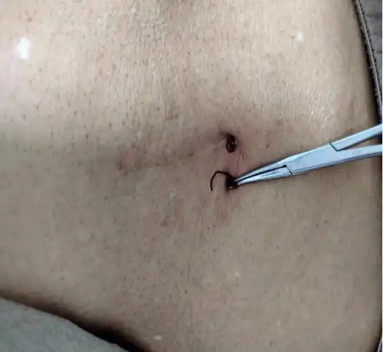 出现线结反应后,大部分在切口处会出现皮肤破溃,渗液,本身并没有严重