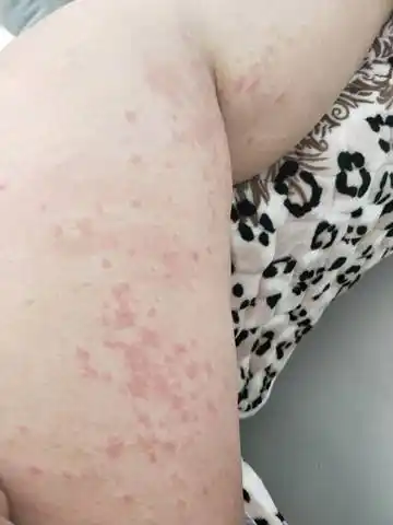 大家帮忙看看这是妊娠痒疹吗?查了血胆红素不高.