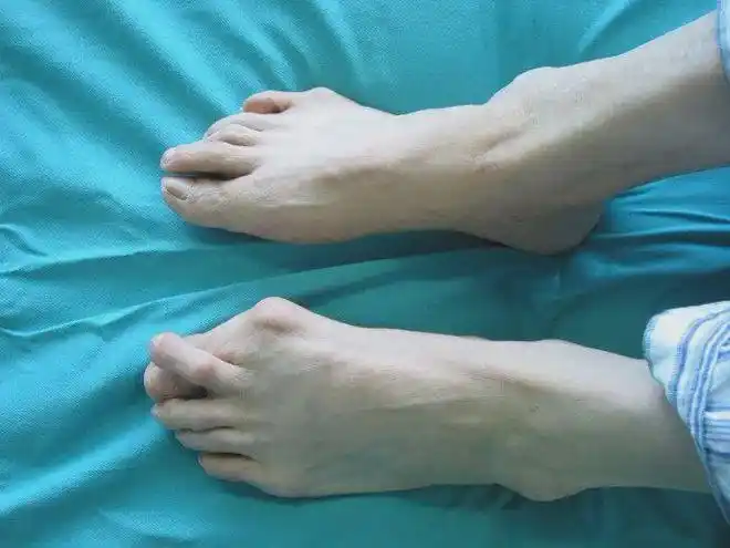 529爱足日我们在行动健康知识宣教一拇外翻