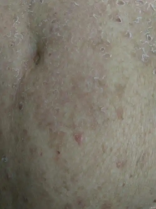 反复全身脓疱伴瘙痒双下肢溃疡20余年