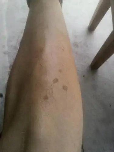 腿上出现这种斑点还在往其他地方蔓延请熟悉的告诉下