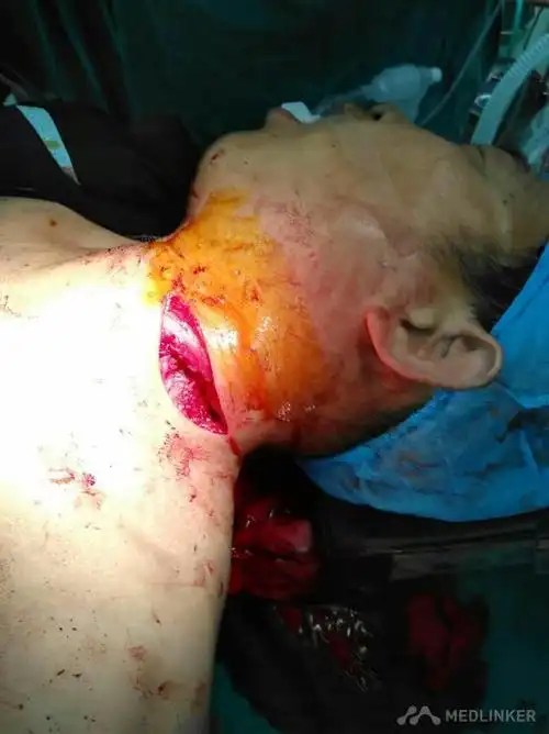 颈部电锯切割伤一例