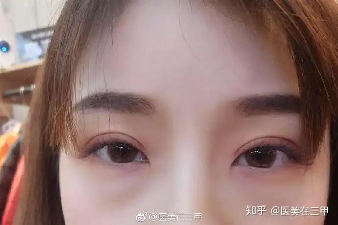 想做小平行的双眼皮的看过来