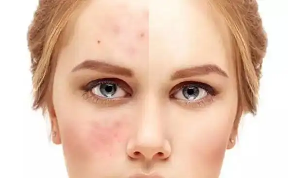 夏天小心被晒成敏感肌,高温天气,护理修复敏感肌肤这么来!_皮肤