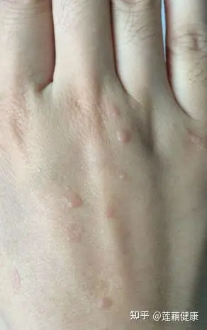 24岁女患者手背长小点点越扣还越多原来是扁平疣在作怪