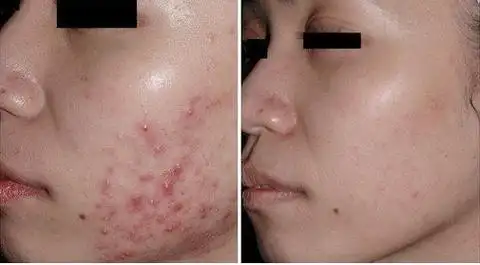 什么是果酸换肤?