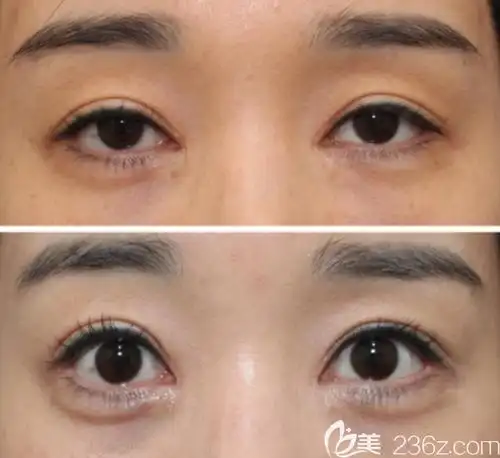 眼部综合修复手术前后对比照片