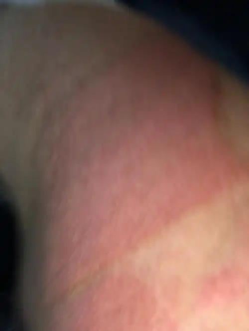 皮肤过敏到处是红点特痒已掻破皮可在患处涂红霉素软膏吗?