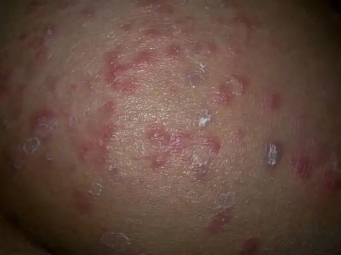 这是不是股藓 用什么药好 长在屁股很痒啊 已经有