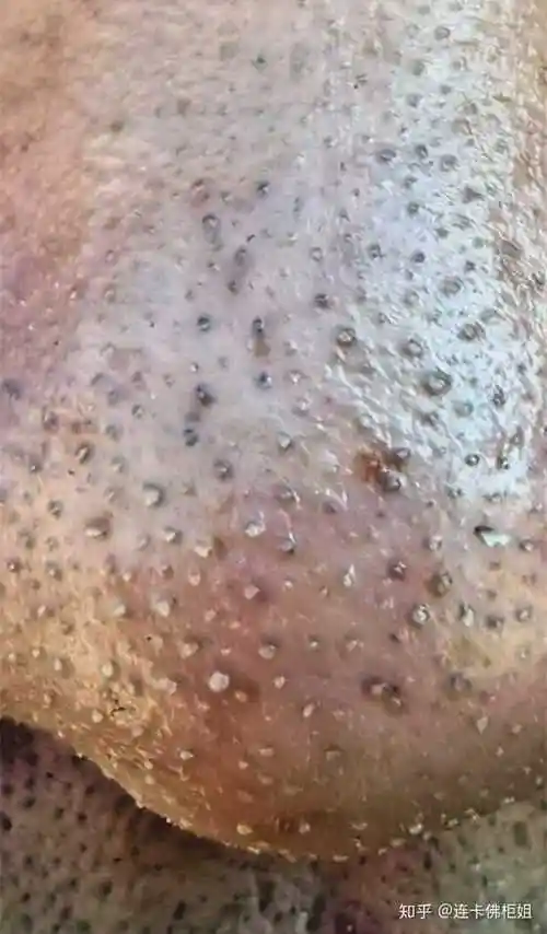 求各位大神,怎么祛黑头,黑头鼻在此!!? - 知乎