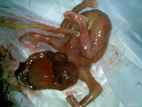 【讨论】大家看看这个胎儿(引产后照片已发20081016) [精华]