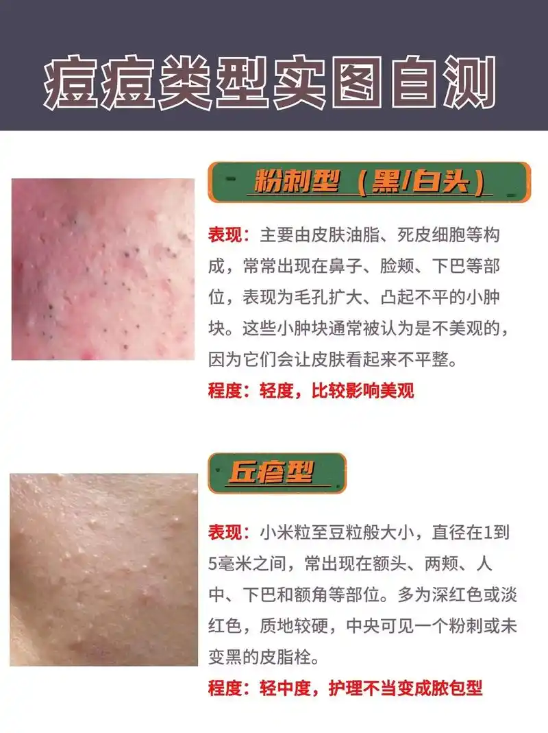 痘痘类型自测.#毛孔粗大 #闭口粉刺 #拯救痘痘肌 #深层毛 - 抖音