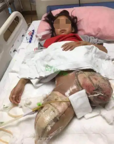 可怜8岁女孩柳石路上学途中遭货车碾压双腿截肢柳州人聚大爱帮