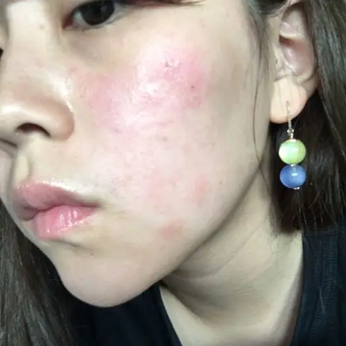 过敏烂脸到痊愈的全过程 敏感肌肤妹子来看 图真慎入