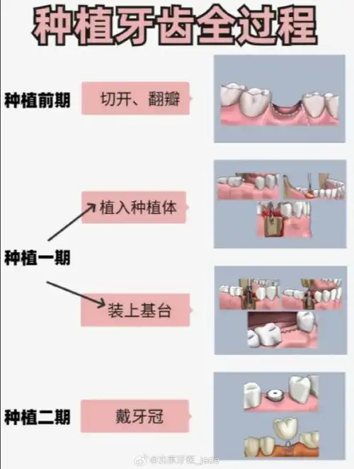 种植牙全过程.