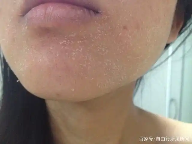 女人肺不好,对皮肤状况有哪些影响?