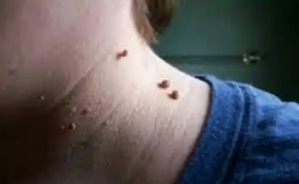 「这种」天然疗法在家做.免挨刀肉瘤自然消!