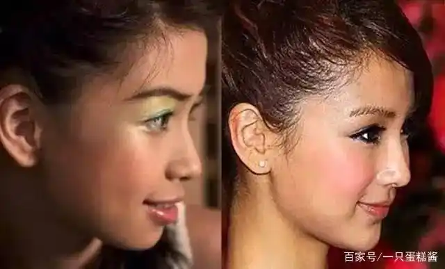 下巴后缩如何改善?