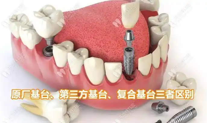 种植牙二期用的原厂基台第三方基台复合基台三者区别是啥