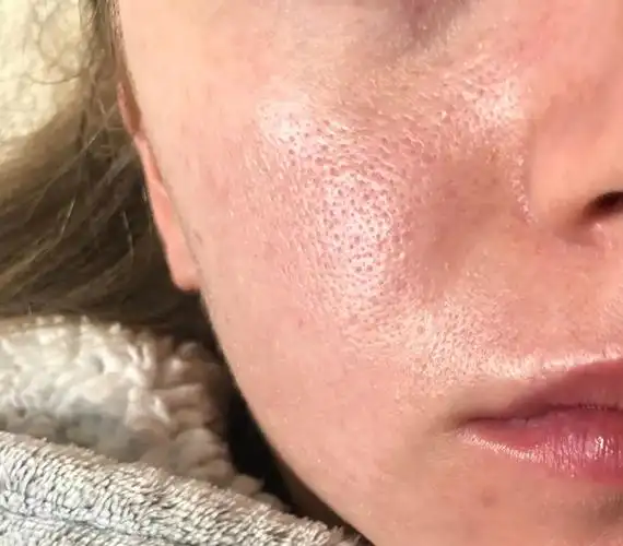 油光型毛孔粗大