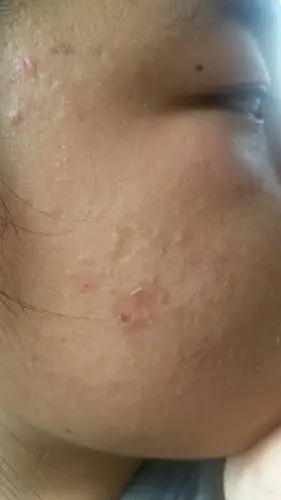 皮肤问题:我现在16岁,性别女,油性皮肤,经常长青春痘,毛孔粗大,皮肤