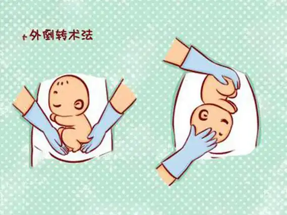 盘点轻松纠正横位胎位的九种方法,侧卧位针灸齐上阵