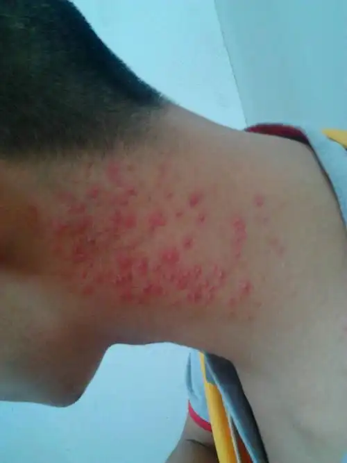 脖子两边起疙瘩怎么办?帮忙谢谢