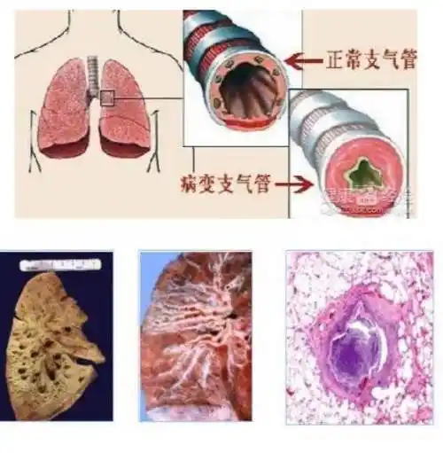 夕阳!宝宝支气管肺炎症状"锱铢必较"-第2张图片-渝北博客
