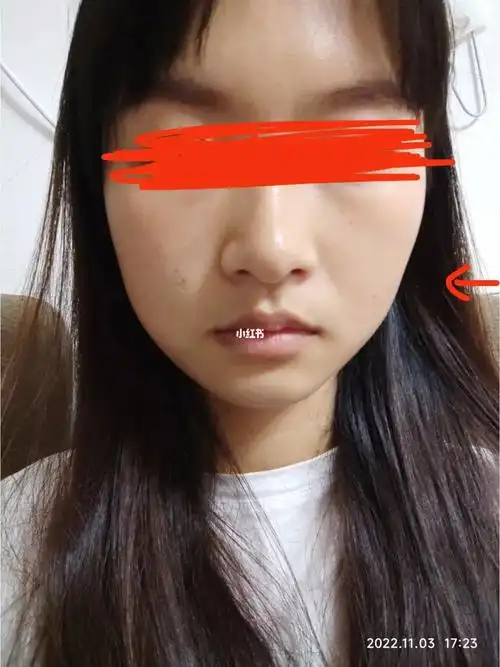 拔完智齿脸凹陷垮了