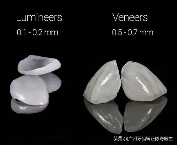 牙齿贴面能维持多久多少钱(牙黄) - 价格百科