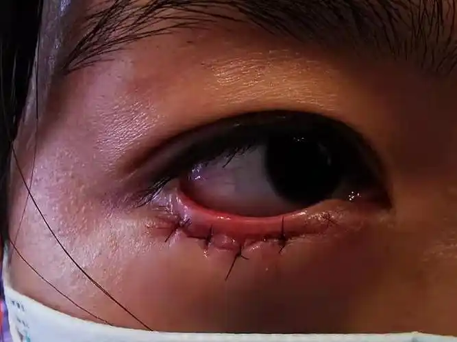 眼睑下至外切第二天没法见人了绝望