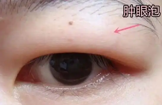 一觉醒来"胖"一圈,赶紧自查是不是中招了|水肿|肾炎|症状|病理性|下肢